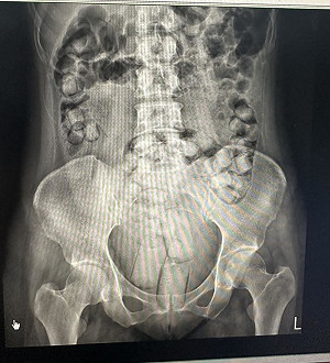 2泰女體內藏115顆海洛英來台　入境遭攔截送辦