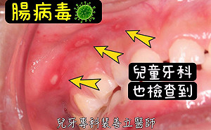 孩子嘴巴多處破洞別以為只是火氣大！醫曝：「這2處」若破恐是腸病毒