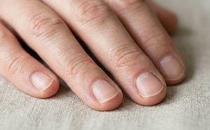 快檢查你的手！醫曝「手部暗藏的7種病兆」：半白指甲可能是腎病