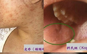 今年首起境外移入麻疹群聚　疾管署公布旅遊警示區