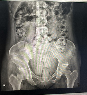 2泰女吞藏海洛因小港機場遭攔現形　一審最重判16年