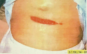 「若22年前319槍擊案身亡，還有馬蔡賴總統嗎？」陳水扁臉書PO傷口照  籲無新發現該「結案」