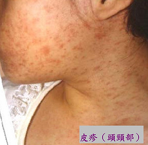 國內新增2起麻疹病例 疾管署呼籲：疑似個案盡速通報
