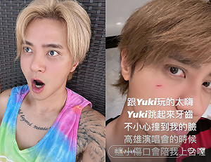 演唱會倒數2天！羅志祥突PO「臉頰受傷照」：傷口會陪我上台