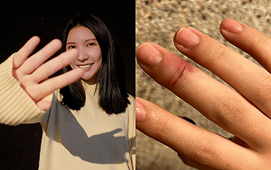 《全明星》田依甯骨折手指歪掉！傷勢畫面流出：穿褲子都難