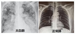 那跟什麼有關? 「大白肺現象」瘋傳 北京「闢謠」：與原毒株、疫苗接種無關
