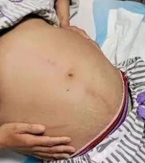 她肚子裏有「蟒蛇」? 女子患「這種病」 手術竟取出「1公尺巨蟒」