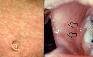 北市麻疹個案曾搭公車、板南線　衛生局籲健康監測