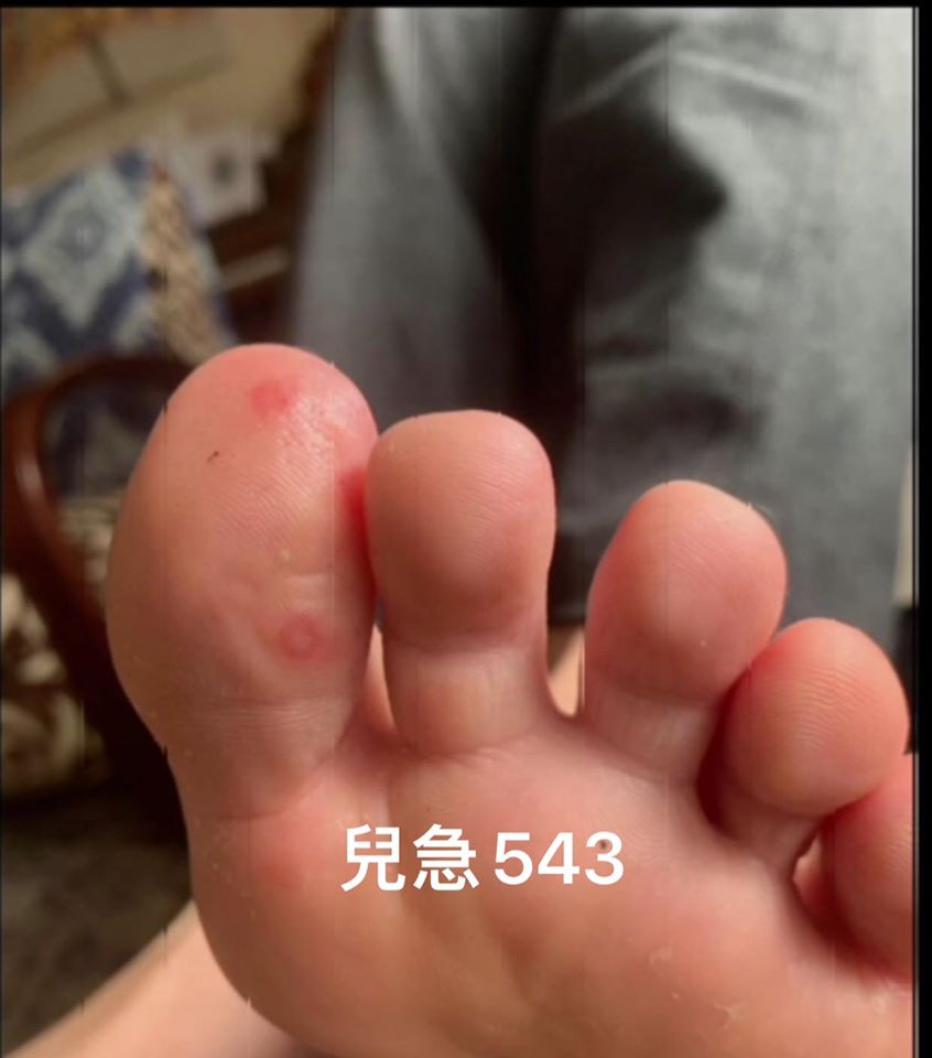 美國兒童皮膚科醫師表示「COVID腳趾」這種類似水痘或麻疹的病變，可能是無症狀兒童患者感染的跡象。 圖：翻攝自來講兒科急診的543-吳昌騰醫師 粉絲專頁