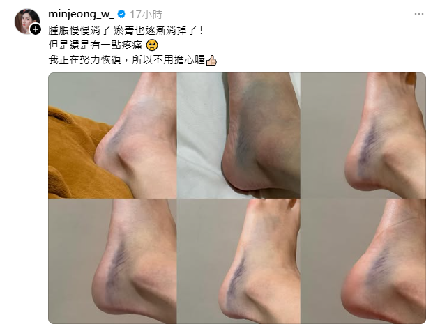 南珉貞曬出最新傷勢，可以看到她的腳踝及腳背仍有大片紫色瘀青。 圖：翻攝自南珉貞Threads