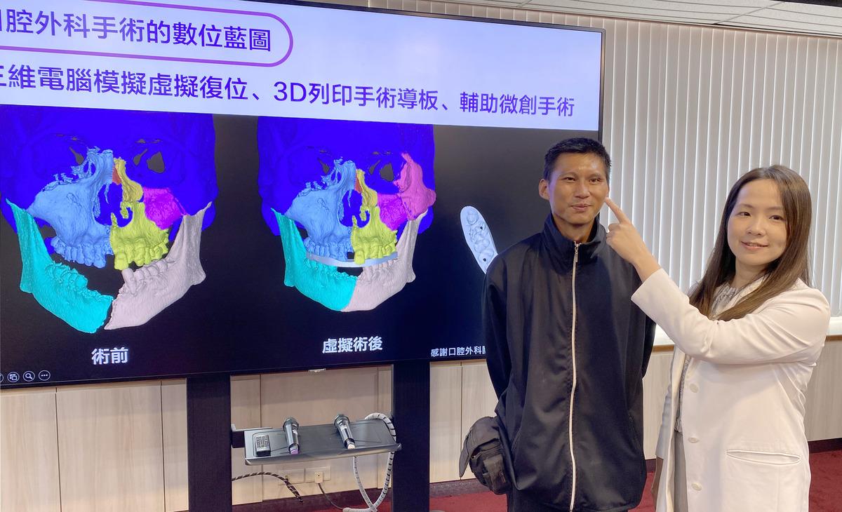 台中榮總口腔醫學部醫師連凱華(右)說明，以微創手術為陳先生重整臉部骨骼及左眼底骨。 圖：台中榮總/提供
