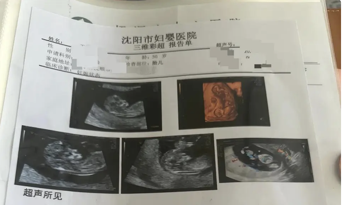 遼寧撫順王女士目前懷孕已 16 週，但去年 11 月至 12 月的四次產檢中，每次彩色超音波（以下簡稱彩超）檢查都顯示多出一名胎兒，最終確認懷上罕見的同卵四胞胎，其中第四胎被診斷為無心畸胎。 圖：翻攝自 極目新聞