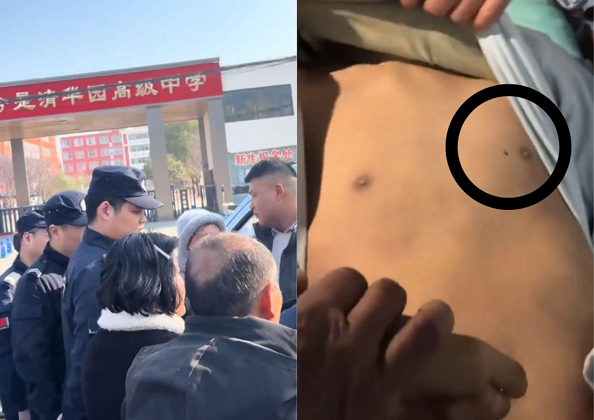 專家認為少年胸口圓洞疑為活體採血，傷口不像外力造成，疑似粗針穿刺心臟吸血。 圖：翻攝自網路