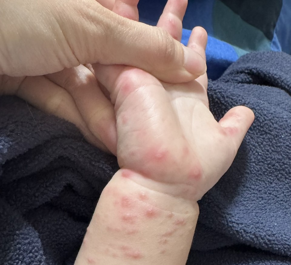 1歲4個月大的男嬰手掌開始紅腫潰爛。 圖：家長提供