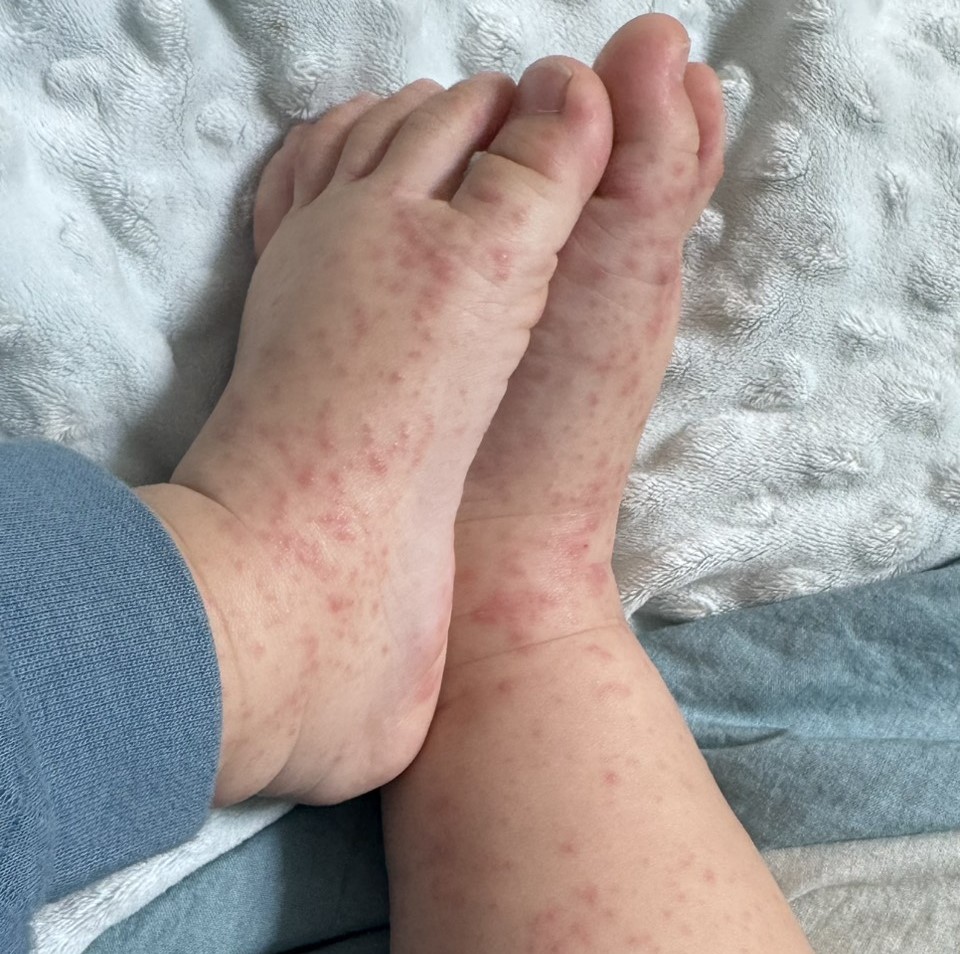 1歲4個月大的男嬰雙腿佈滿水泡，令大人看了心疼。 圖：家長提供