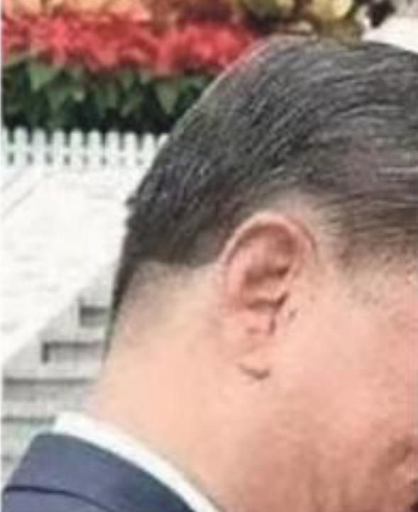 李大宇稱2024年7月盛傳習近平中風住院，越通社照片顯示其右腦後側L型刀疤疑似手術痕跡。 圖：翻攝越南通訊社