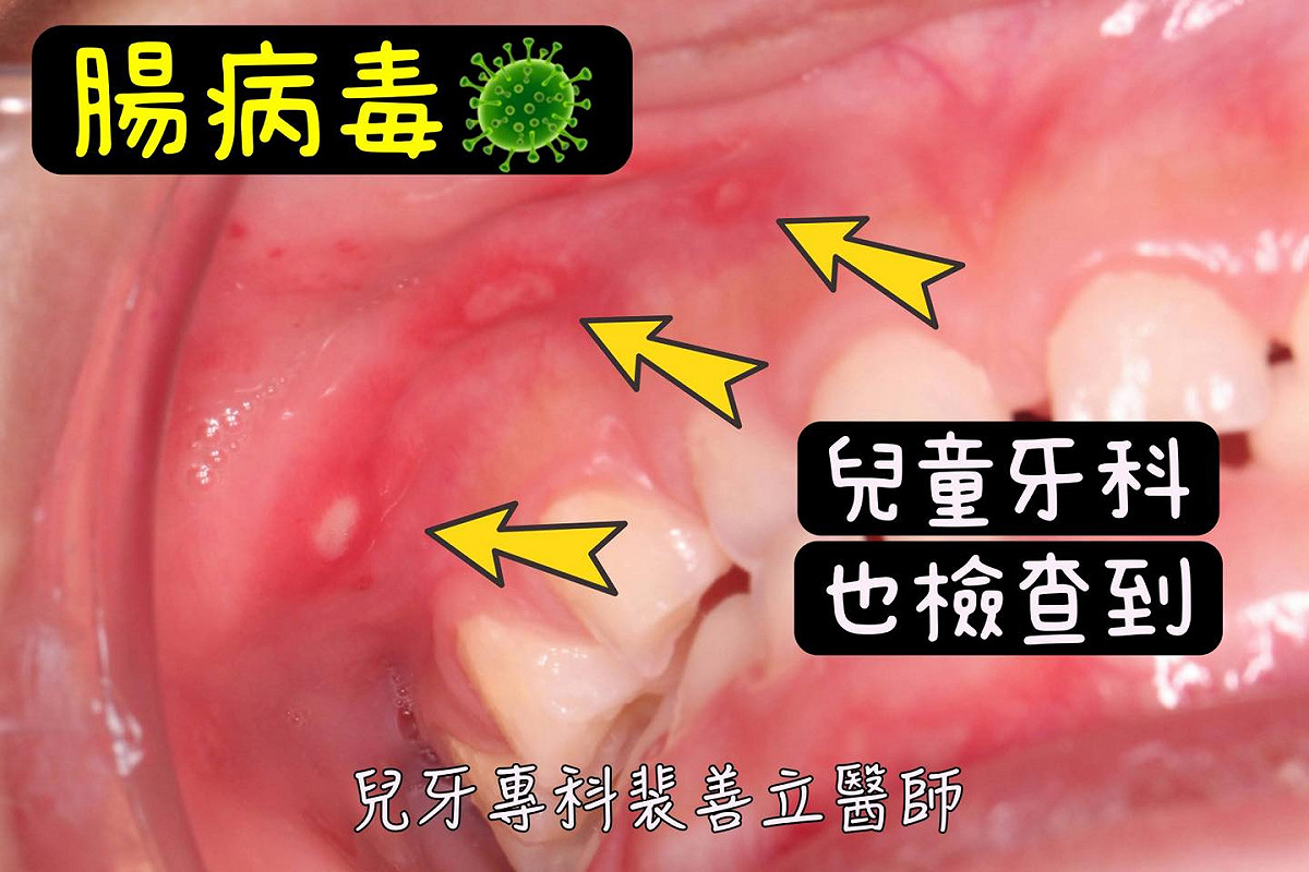 兒童牙醫裴善立提醒家長，腸病毒疫情升溫，應注意孩子口底與喉嚨潰瘍，避免誤認為火氣大，並及早就醫檢查。 圖：翻攝自「這齒有點不一樣｜兒童牙醫Dr.裴叔叔」臉書專頁