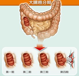 大腸癌的確可能會有某些症狀，但有症狀基本上要到第二期、甚至第三期以上，而早期大腸癌幾乎沒有症狀。 圖：取自全民健康基金會網站