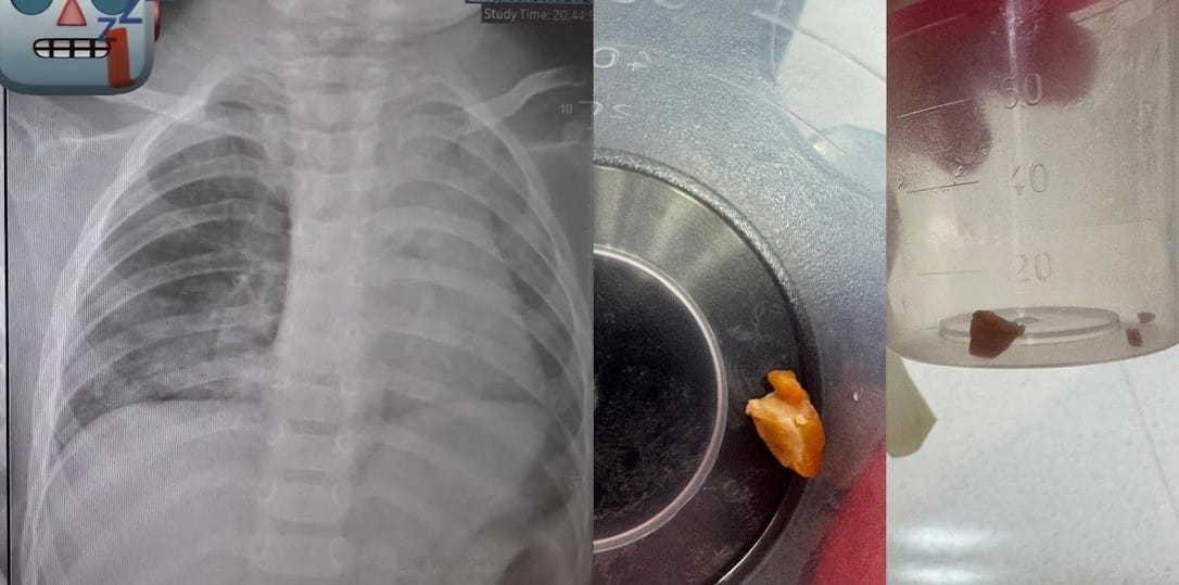 1歲童被阿嬤餵食花生，竟致肺塌陷，小兒科醫廖穗綾籲4歲以下禁食堅果防窒息風險。 圖：翻攝自臉書粉絲頁「廖穗綾醫師的健兒門診-Hablo Español」