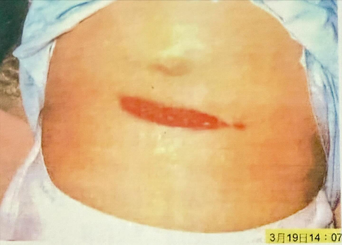 前總統陳水扁19日在臉書PO出22年前319槍擊案，腹部受創傷口照片。 圖：翻攝「臉書」YonGe Chen