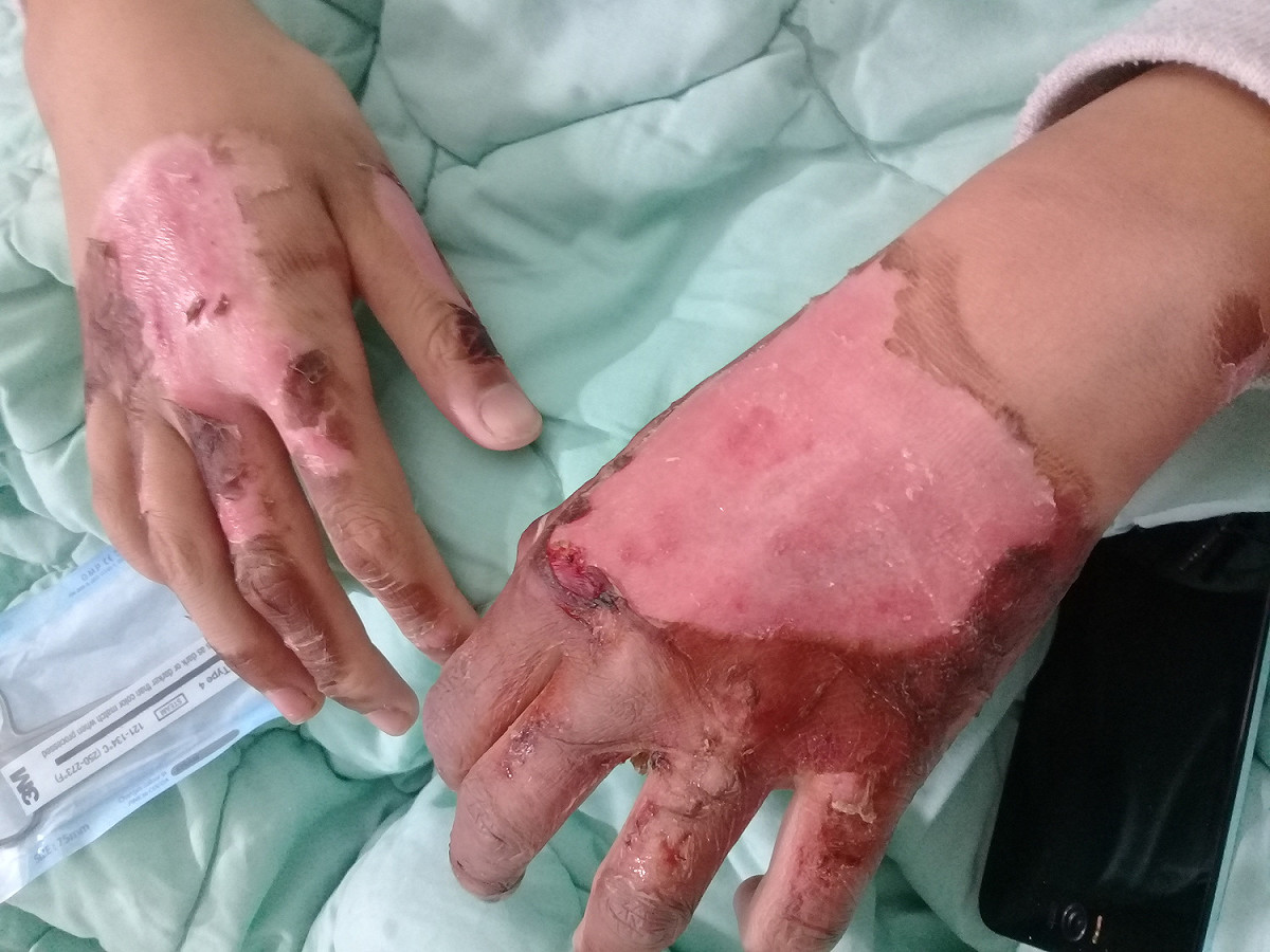 蔡姓父女住院近一個月才出院，蔡父對於女兒受傷十分心疼及自責，所幸兩人傷勢不重並已持續在陽光基金會南區中心進行復健、心理諮商及壓力衣服務。 圖：陽光基金會／提供