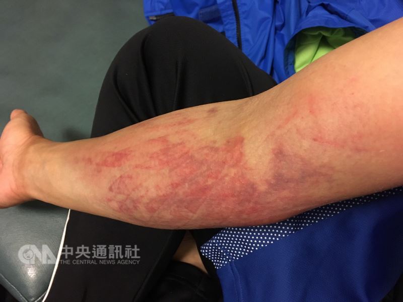舉重教練蔡溫義表示，許淑淨整隻手臂瘀血，肌肉韌帶撕裂傷，可能至少需休息一個月。圖為許淑淨受傷的手臂。 圖 : 教練蔡溫義/提供