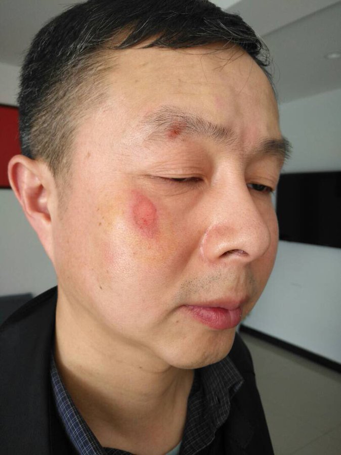 根據李蔚在午夜過後發出的照片顯示，他的臉部受傷、左腳流血、後腦部血腫、左右手腕受傷。 圖：翻攝自推特