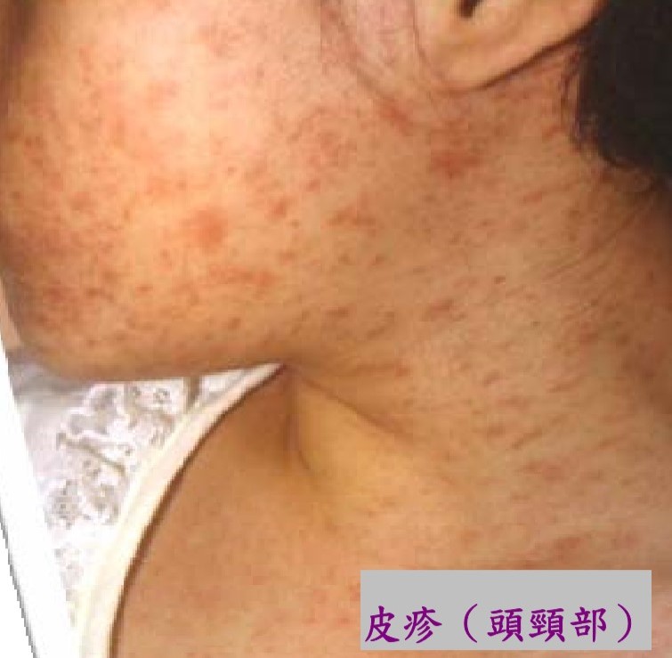 麻疹的症狀之一皮疹。 圖 : 台中市衛生局/提供