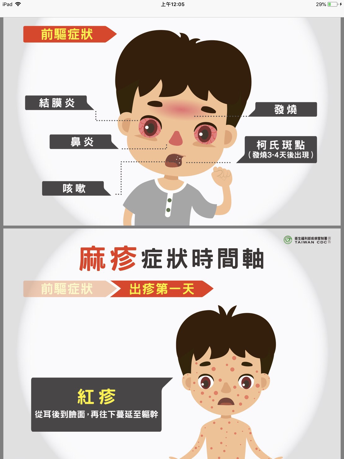 一旦感染麻疹，將出現發高燒、流鼻水、咳嗽、鼻炎、結膜炎等症狀，發燒3至4天後，口腔下臼齒的內頰側黏膜上，會出現典型的柯氏斑點。 圖：衛福部疾管署／提供