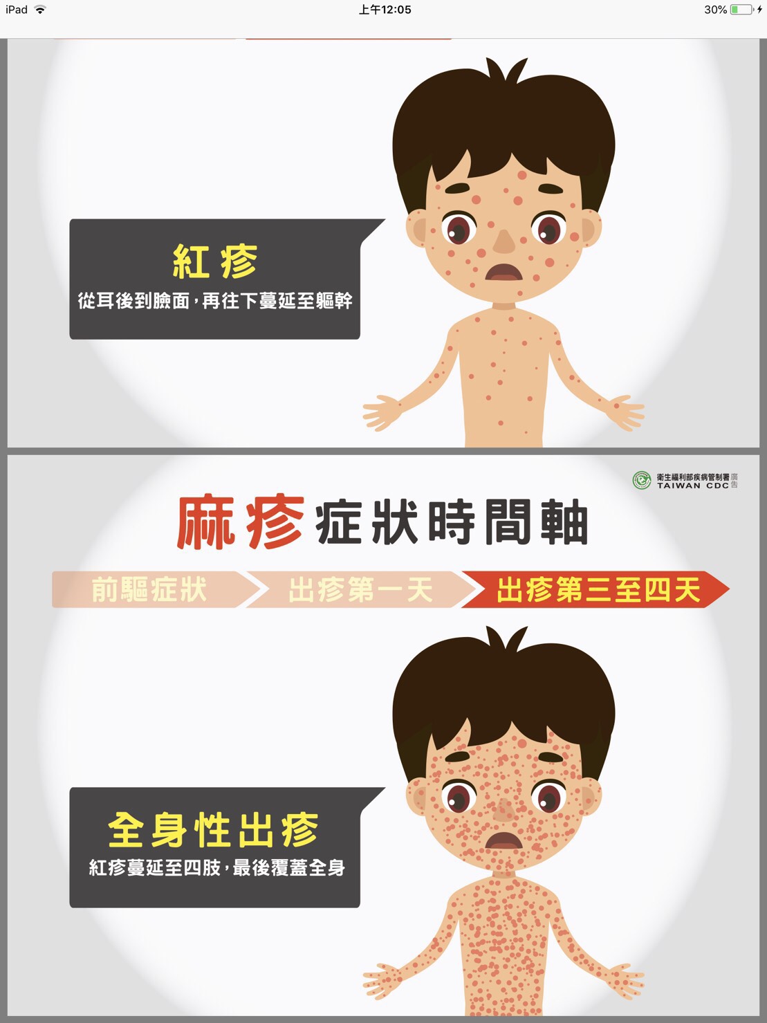 長出柯氏斑點後，緊接著耳後惠出現典型的「斑丘疹」，之後再擴散長滿整個臉面，斑丘疹並會由上向下、從頭長到腳遍布全身。 圖：衛福部疾管署／提供