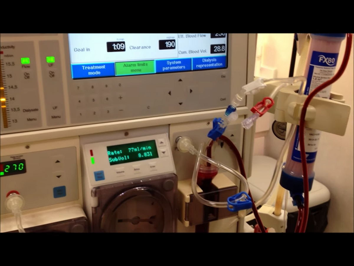 台大醫院加護病房發生替重症患者洗腎時，誤將自來水當成RO逆滲透水使用，共有6名患者受影響，其中一人事發後死亡。但台大內部調查證據顯示，接錯管路和病人死亡無關。圖為一般洗腎設備，但與這次台大醫院出錯案例無關。 圖：翻攝自Youtube