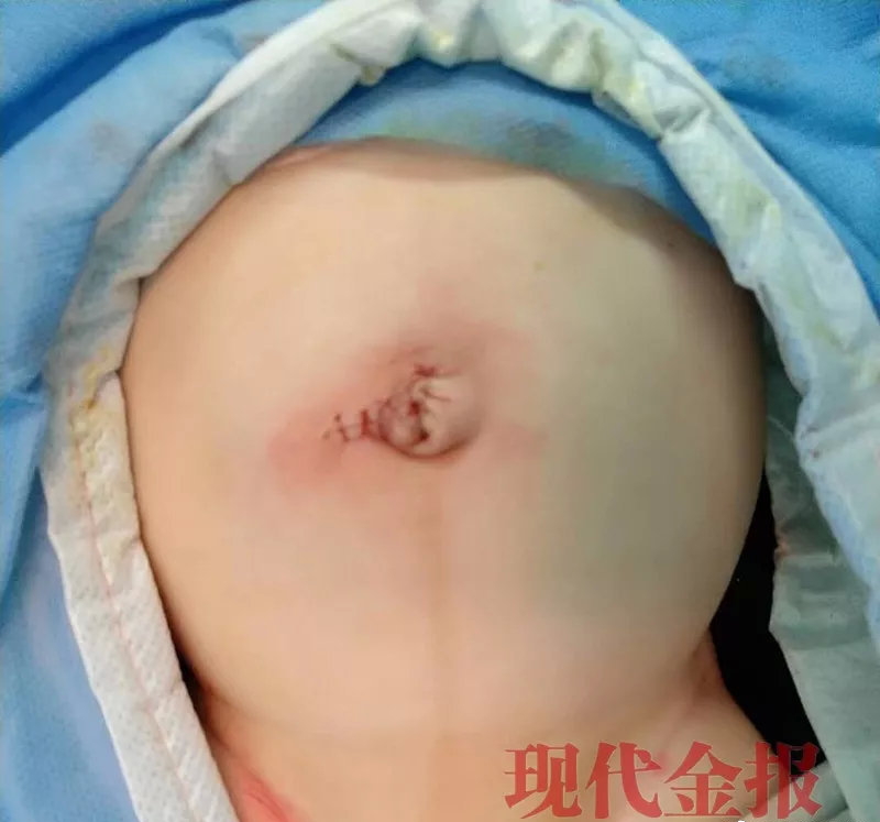 兒子肚臍「鼓鼓的」　無知父母拿刀片「放氣」害腸子流出。 圖／翻攝自現代金報, 2019.01.29