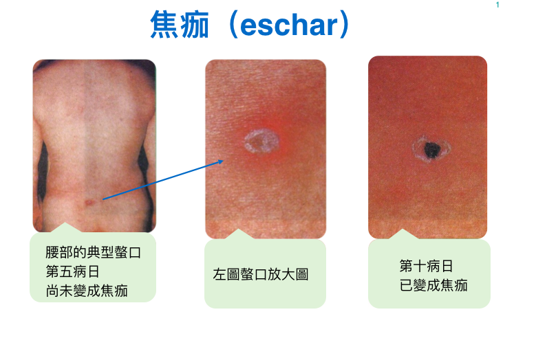 被恙蟎叮咬的地方會出現焦痂。 圖：衛福部疾病管制署/提供