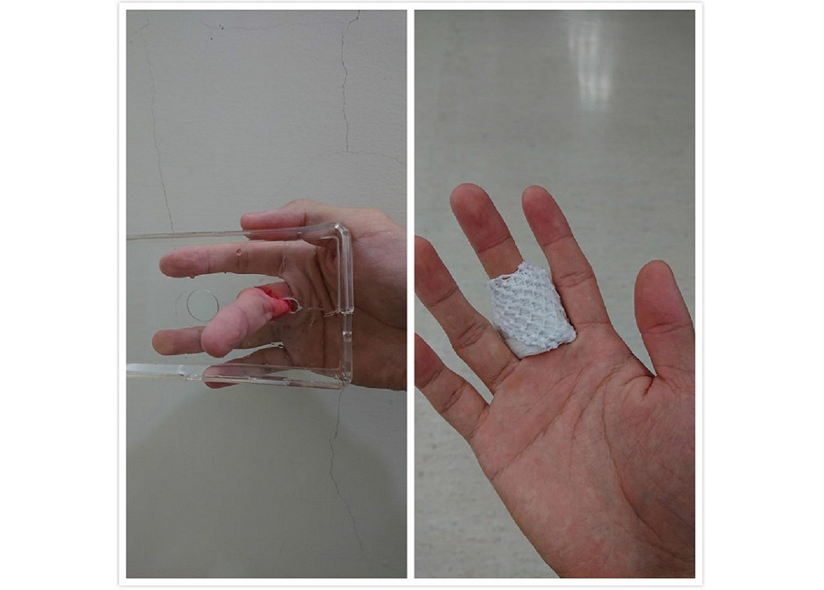 全台首例！男手指卡機殼滲血，他呼籲「千萬別買硬殼」。 圖／取自臉書社團爆怨公社