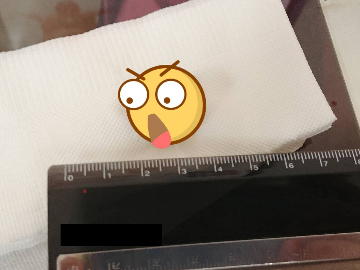 喉嚨卡卡、口腔有異味，就醫檢查發現口腔 2 公分大的球狀物。 圖／改自亞大附屬醫院