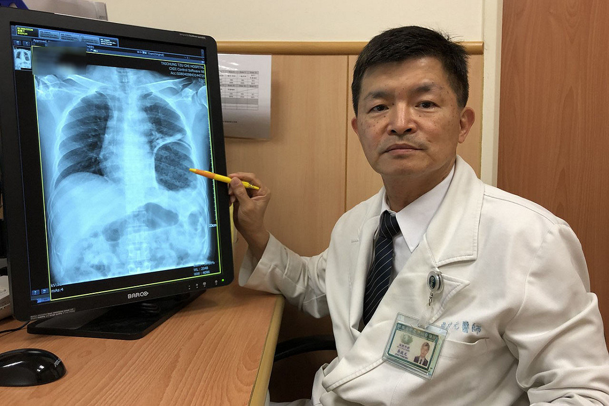李先生排便太用力，竟導致胃跑到胸腔。 圖／台中慈濟醫院提供