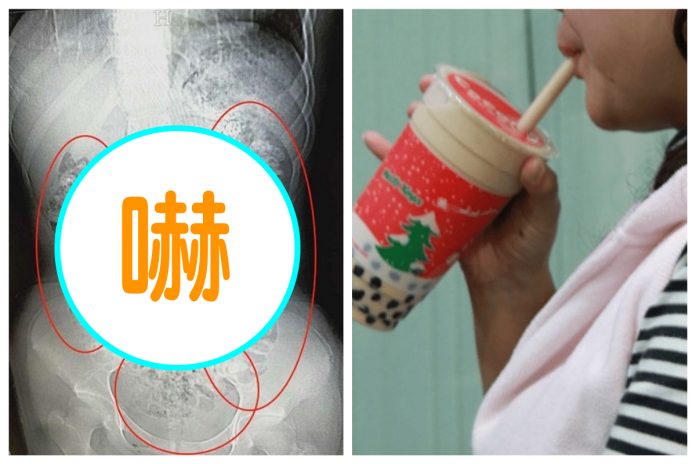 ▲少女因為腹痛到醫院照電腦斷層掃描，驚見肚子裡有上百顆「顆粒狀陰影」，讓人看了頭皮發麻。 合成圖／翻攝自浙江新聞／NOWnews 資料圖片