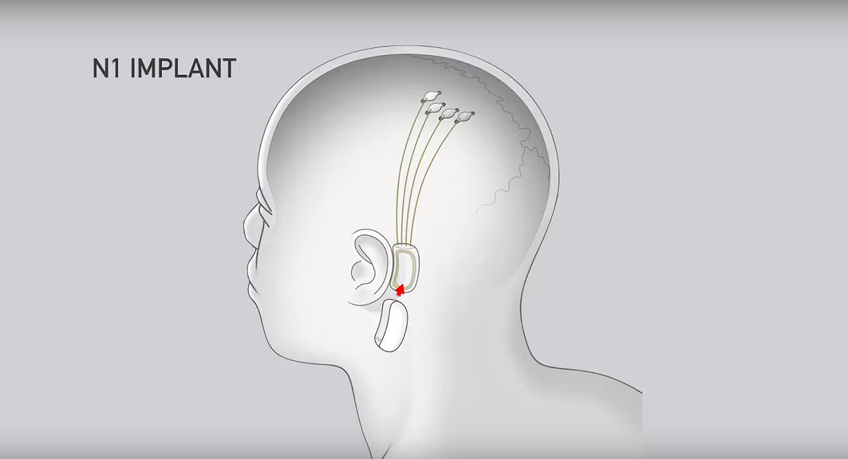 人腦未來將接上網路？馬斯克新項目，將晶片無痛植入人腦中。 圖：Neuralink／YouTube
