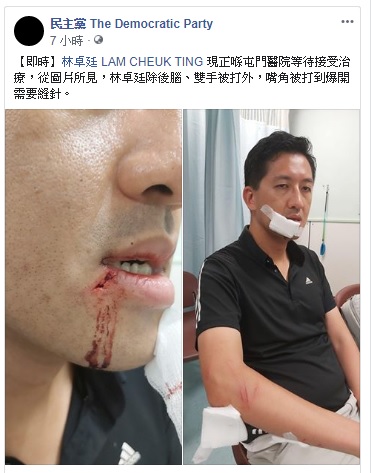 香港立法會議員林卓廷也遭到白衫軍打到濺血，縫了好幾針。 圖：翻攝自香港民主黨臉書