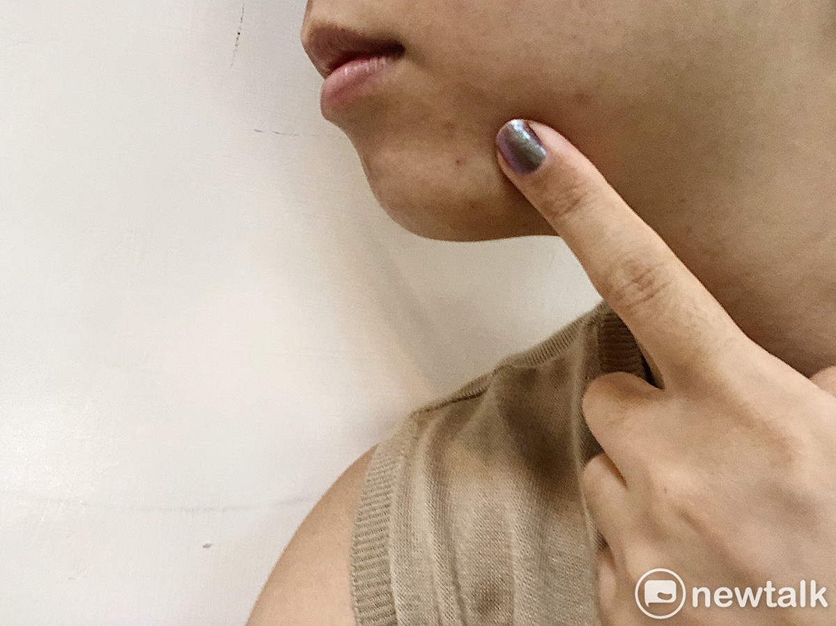 食藥署指出，並非每種口服避孕藥都有改善青春痘之效果。 圖：葉宜哲／攝