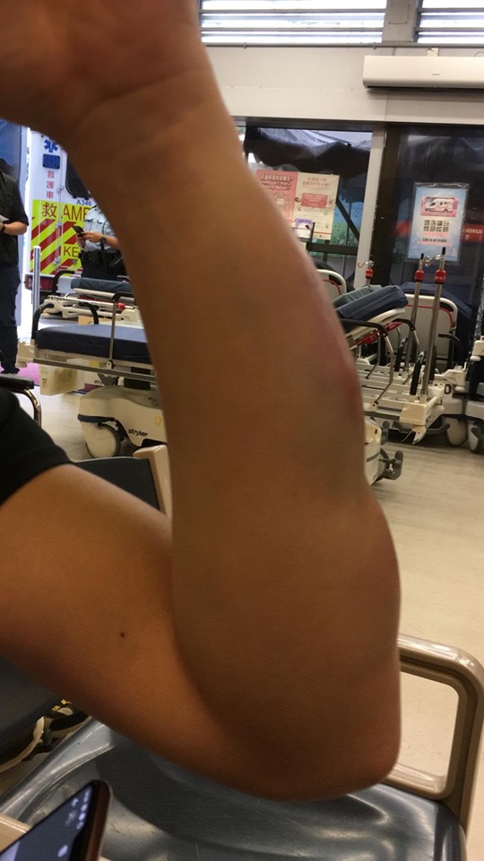 民陣PO出保護岑子杰友人手臂遭棍棒打傷後產生瘀青、腫脹的照片。 圖：翻攝民間人權陣線 Civil Human Rights Front臉書