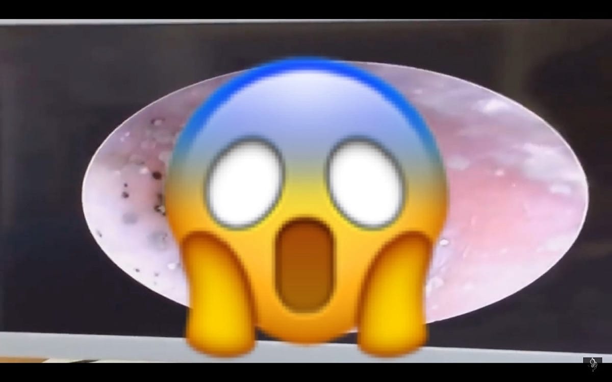 現代人常常會挖耳朵或擠痘痘，甚至更厲害的可以自己擠出黑頭粉刺，但若清得太乾淨的話，可能就會有意想不到的事情發生。 圖／翻攝自影片