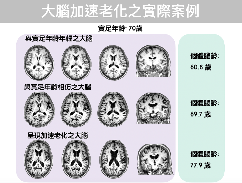 人類腦齡估算一直以來都是用實足年齡作為參考依據，但是人腦會隨著年齡增長逐漸老化，伴隨認知功能下降、行為改變與臨床病變等。 圖 :	陽明大學提供