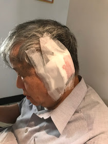 監委陳師孟上週開刀割除了左耳背上的一顆惡性腫瘤，所幸經過進一步切片化驗之後，得知癌細胞沒有擴散，讓他心中寬心不少， 圖：擷取自陳師孟的尖尾週記。