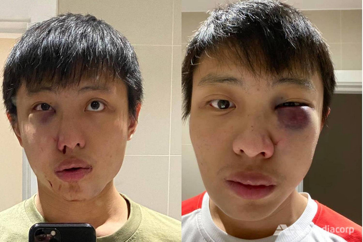 受武漢肺炎疫情影響，新加坡留學生莫顯強(Jonathan Mok)在英國倫敦牛津街頭遭4名歹徒暴打，臉部受創嚴重。 圖：擷取自Jonathan Mok臉書