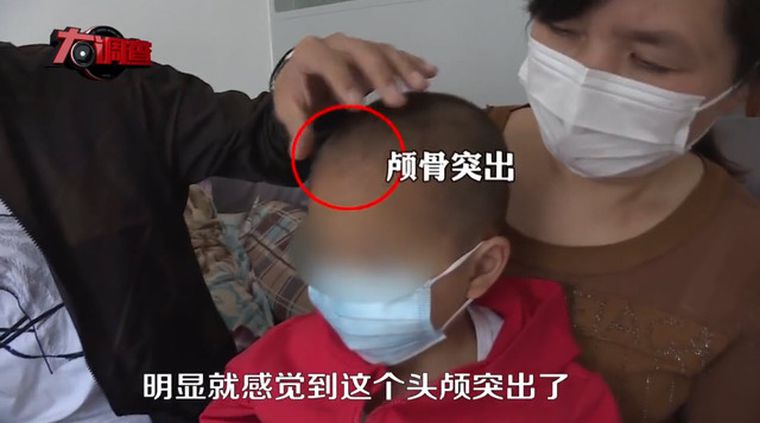 湖南再出現假奶粉事件，多名兒童引用一款名為「倍氨敏」的「特醫奶粉」（特殊醫學用途嬰兒配方食品）後，全身長溼疹、體重下降，且頭骨變大，成為「大頭娃娃」。 圖:擷取自twitter