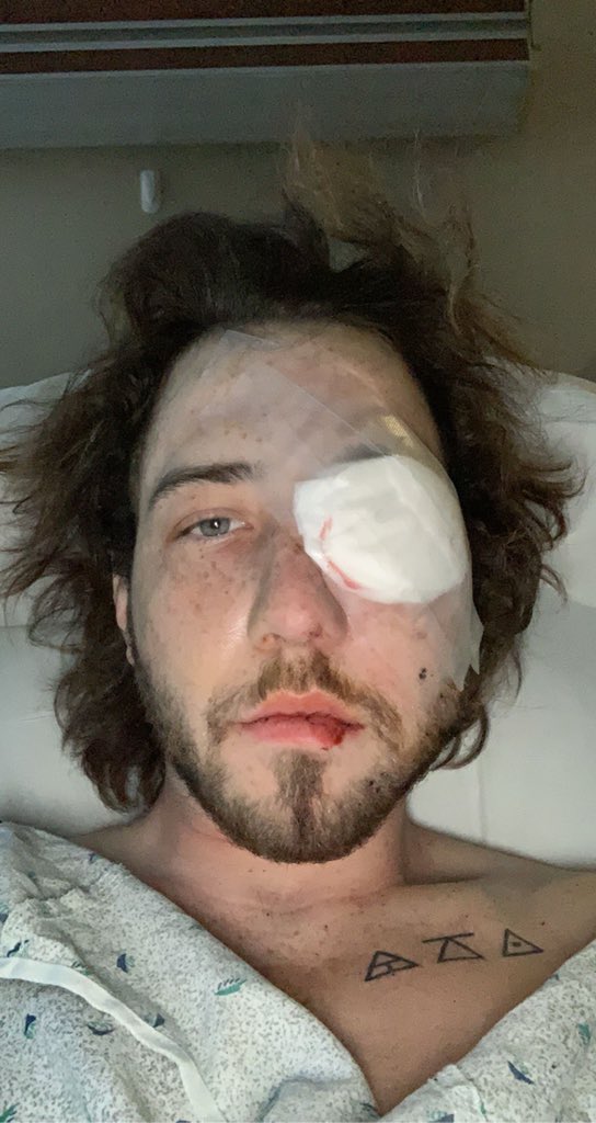這名遭催淚彈擊中的男子名為布雷克（Balin Brake），他上週六參與在韋恩堡舉行的示威活動。 圖：翻攝自Twitter@notbalin