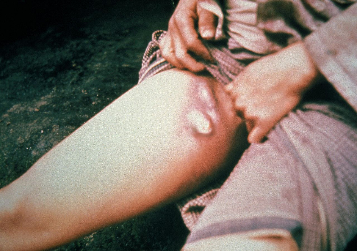線鼠疫最嚴重可導致大腿淋巴爆開。 圖:擷取自WIKI