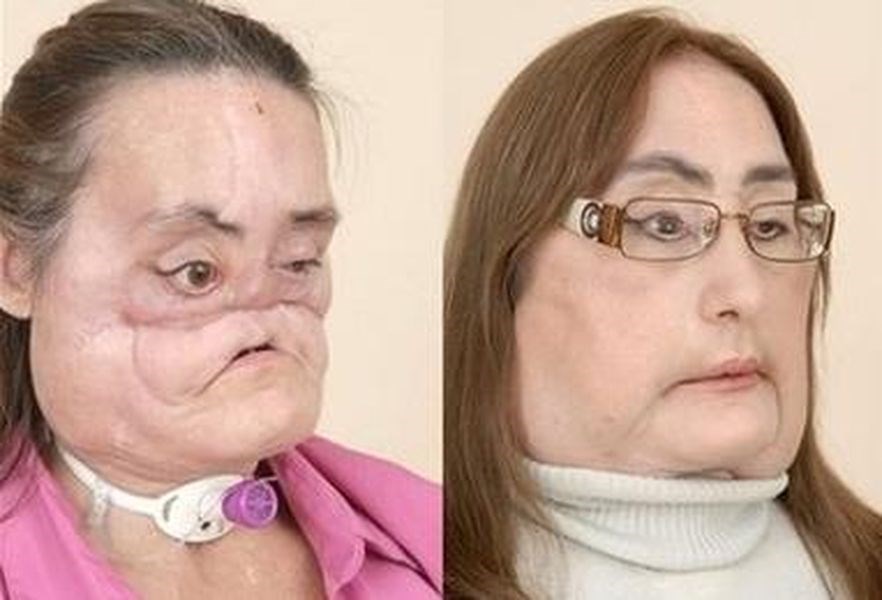 美國首名接受臉部局部移植的卡普已於7月底逝世，享年57歲。 （圖取自維基共享資源網頁；作者Source，Fair use）