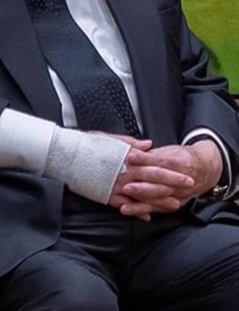 陳耀昌指出，森喜朗他的右手肘紗布下，有個「靜脈留置針」，還有墊針頭的酒精綿球露出一小部分。 圖：翻攝蔡英文推特